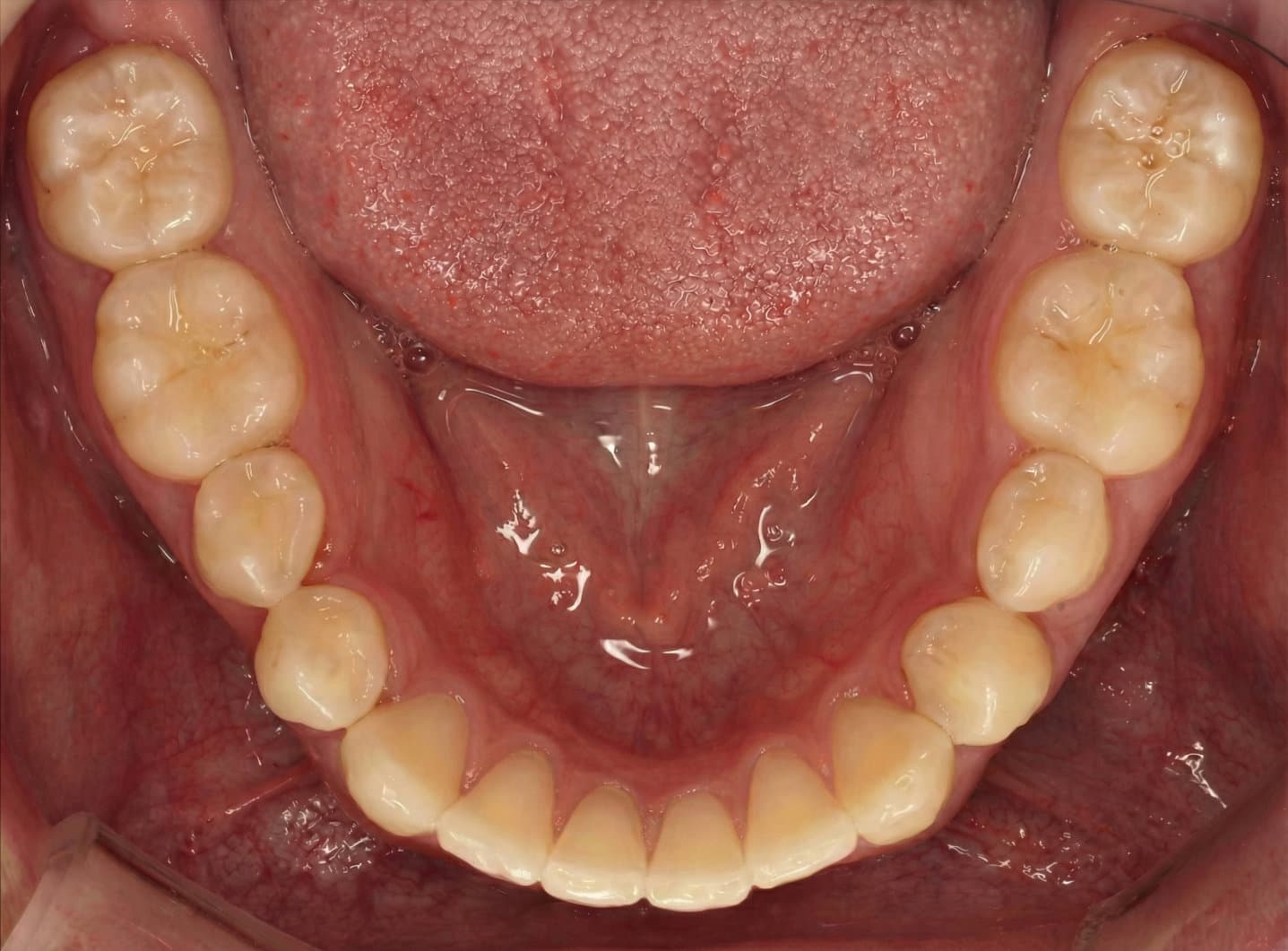 After Invisalign, 6 meses