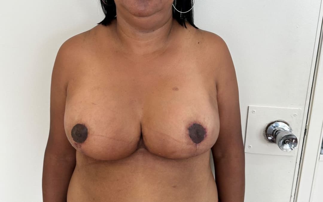 After Reduction mammaplasty