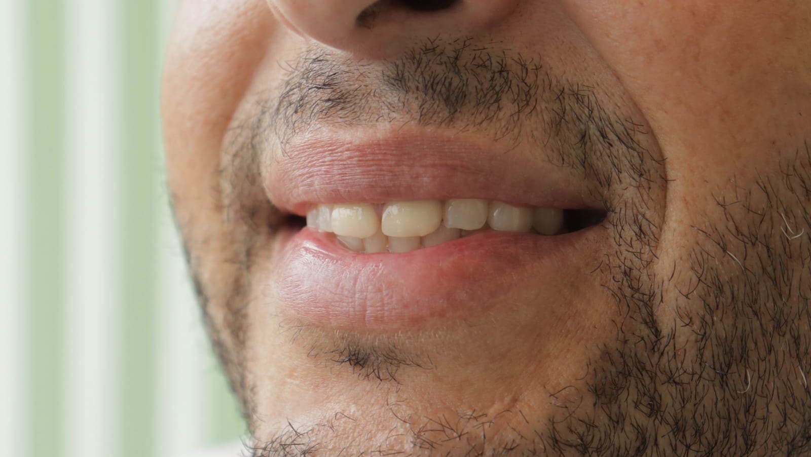 Before Lentes Cerámicos Naturales