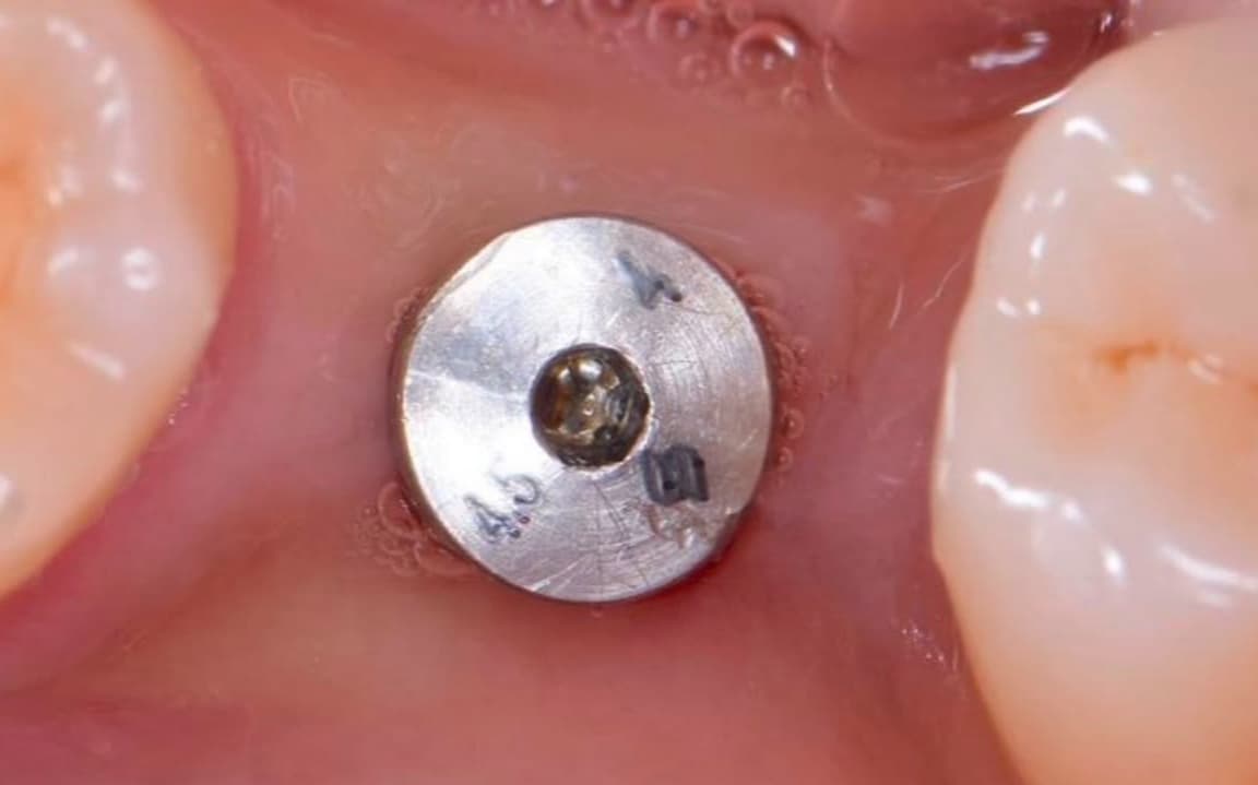 Before Dental Implant and Zirconia Crown on Implant