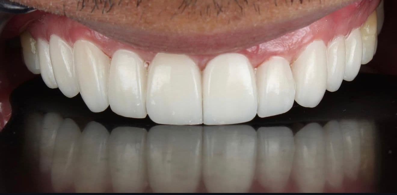After carillas dentales en cerámica