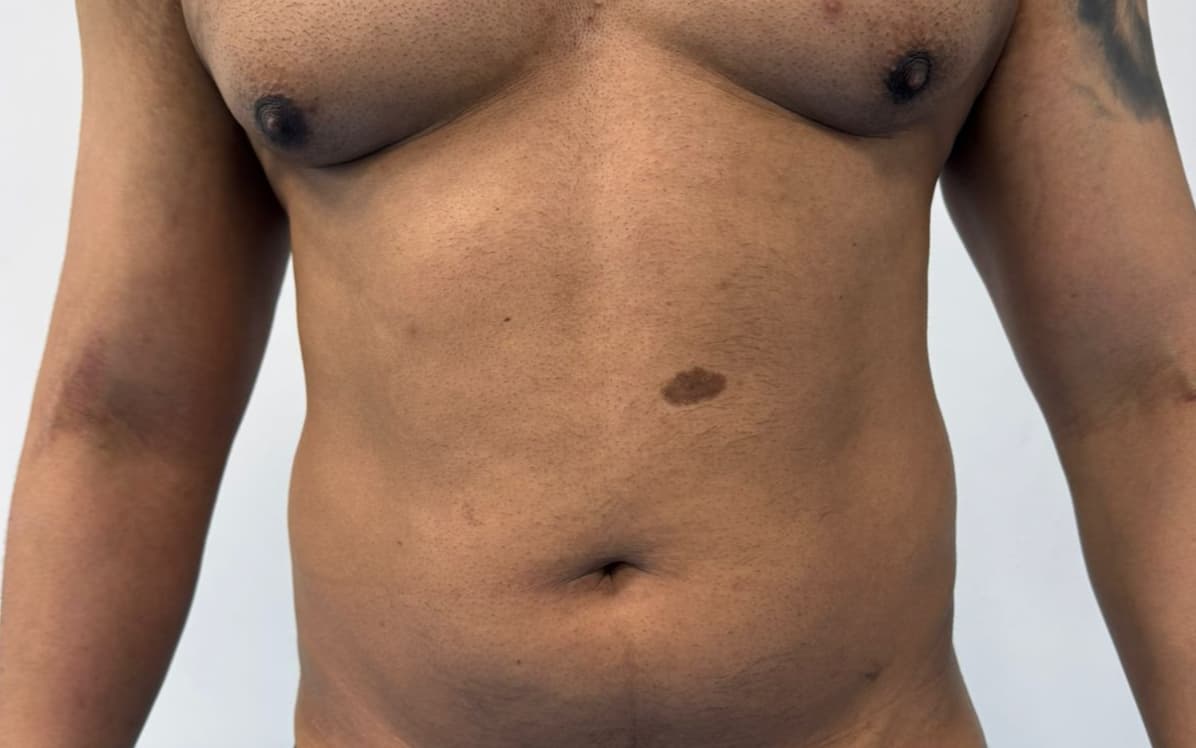 Before Male liposuction