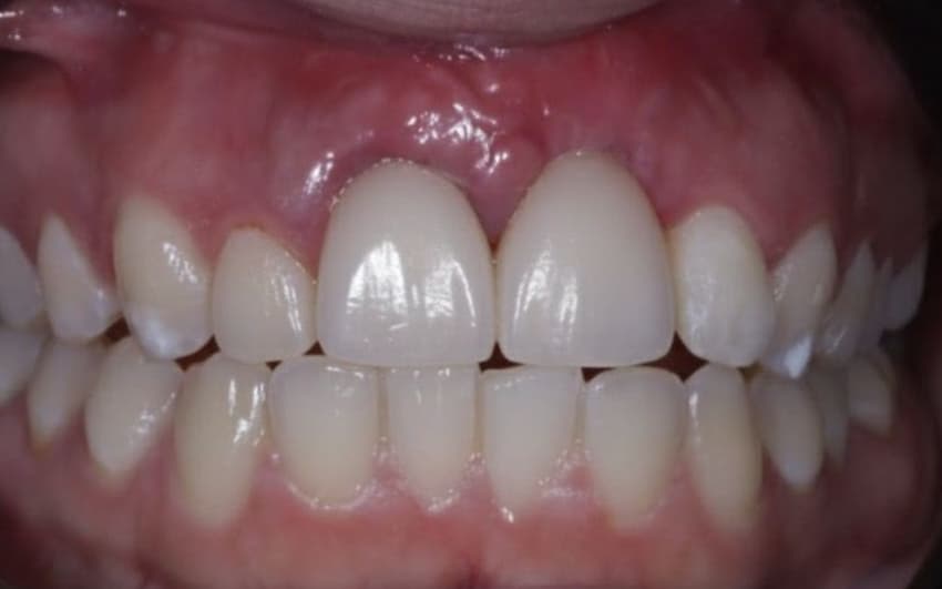 After Dental Implant and Zirconia Crown on Implant