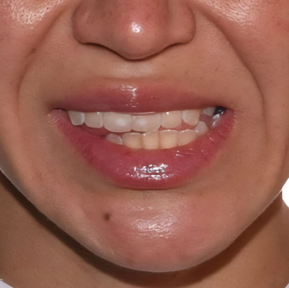 Before Cirugia Ortognatica