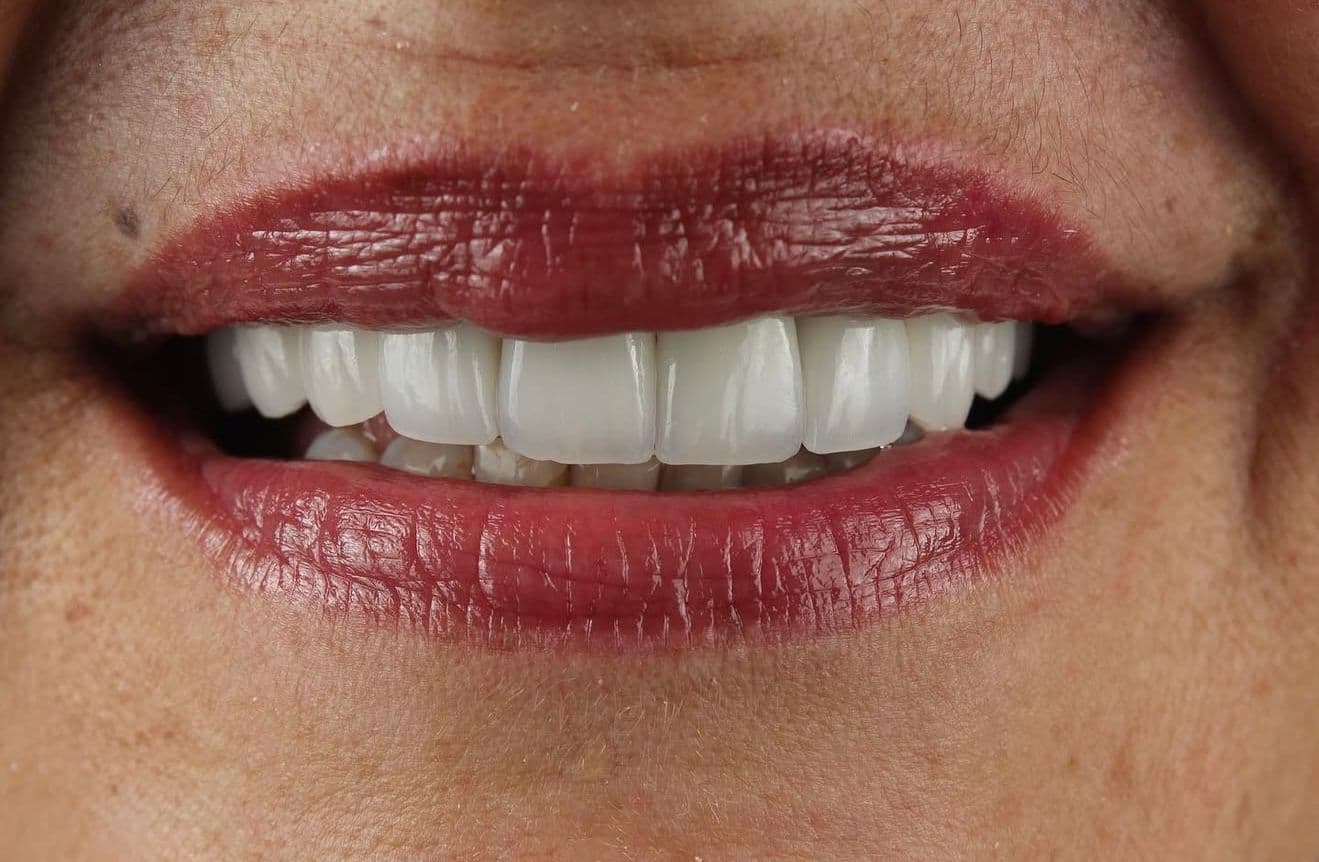 After carillas dentales en cerámica e implante