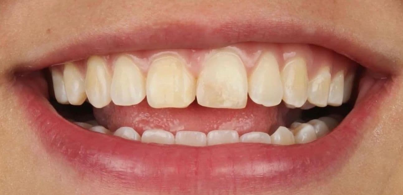 Before carillas dentales en cerámica