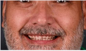 Before Diseño. de sonrisa