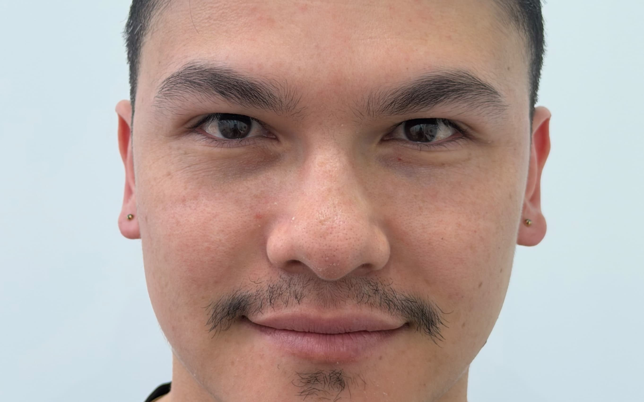 Before Male rhinoplasty