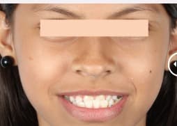 Before Ortodoncia Invisible