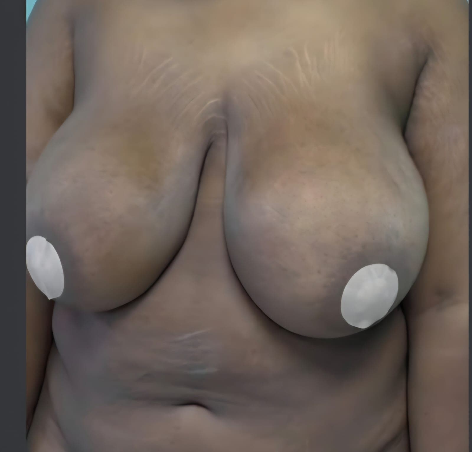 Before Reducción de senos sin implantes