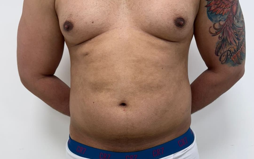 Before Male liposuction + gynecomastia correction