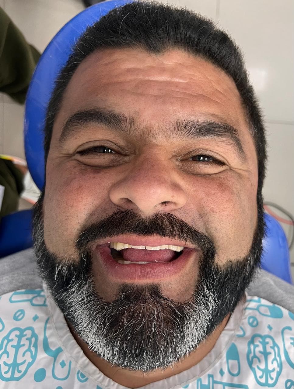 Before LENTES CERAMICOS