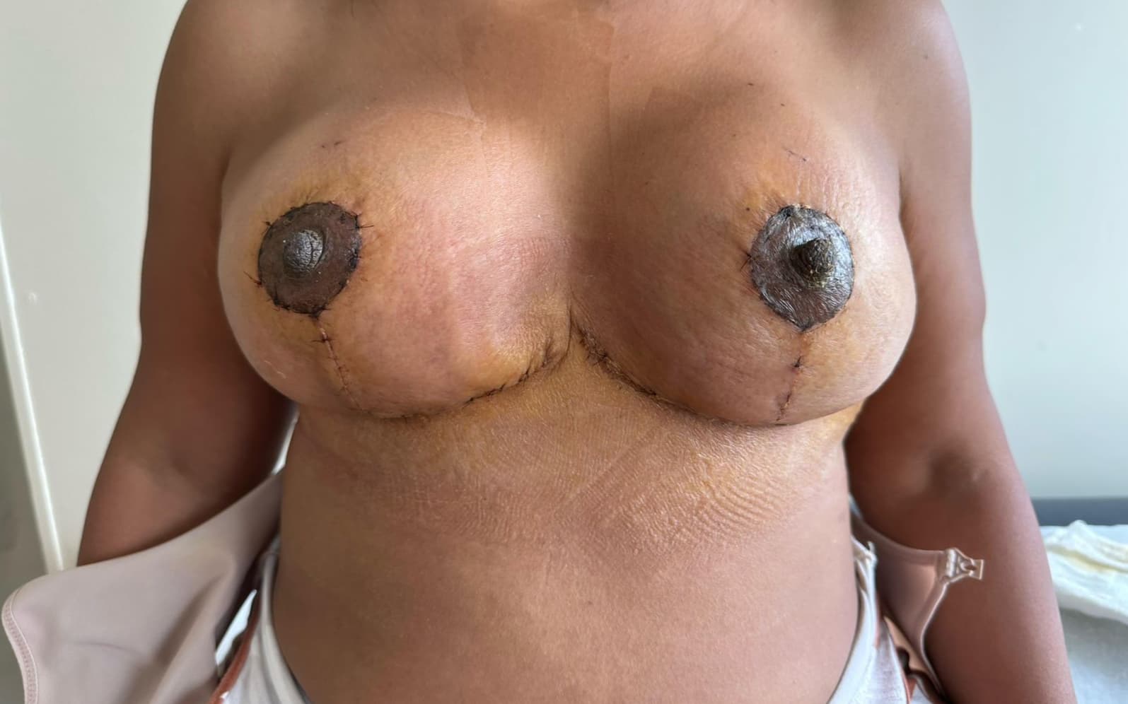 After Mastopexy