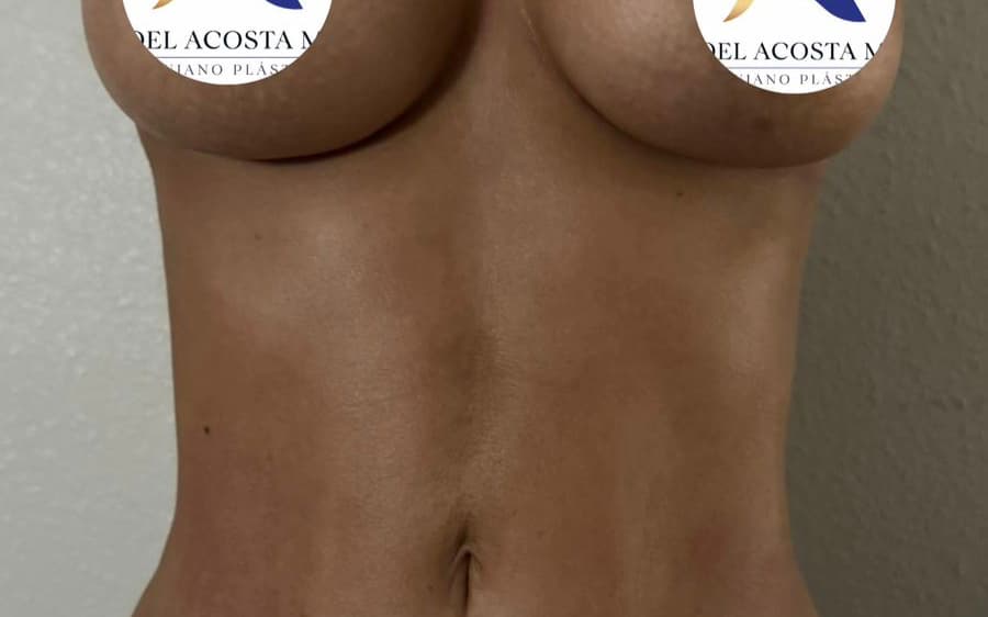 After Liposuction plus breast augmentation
