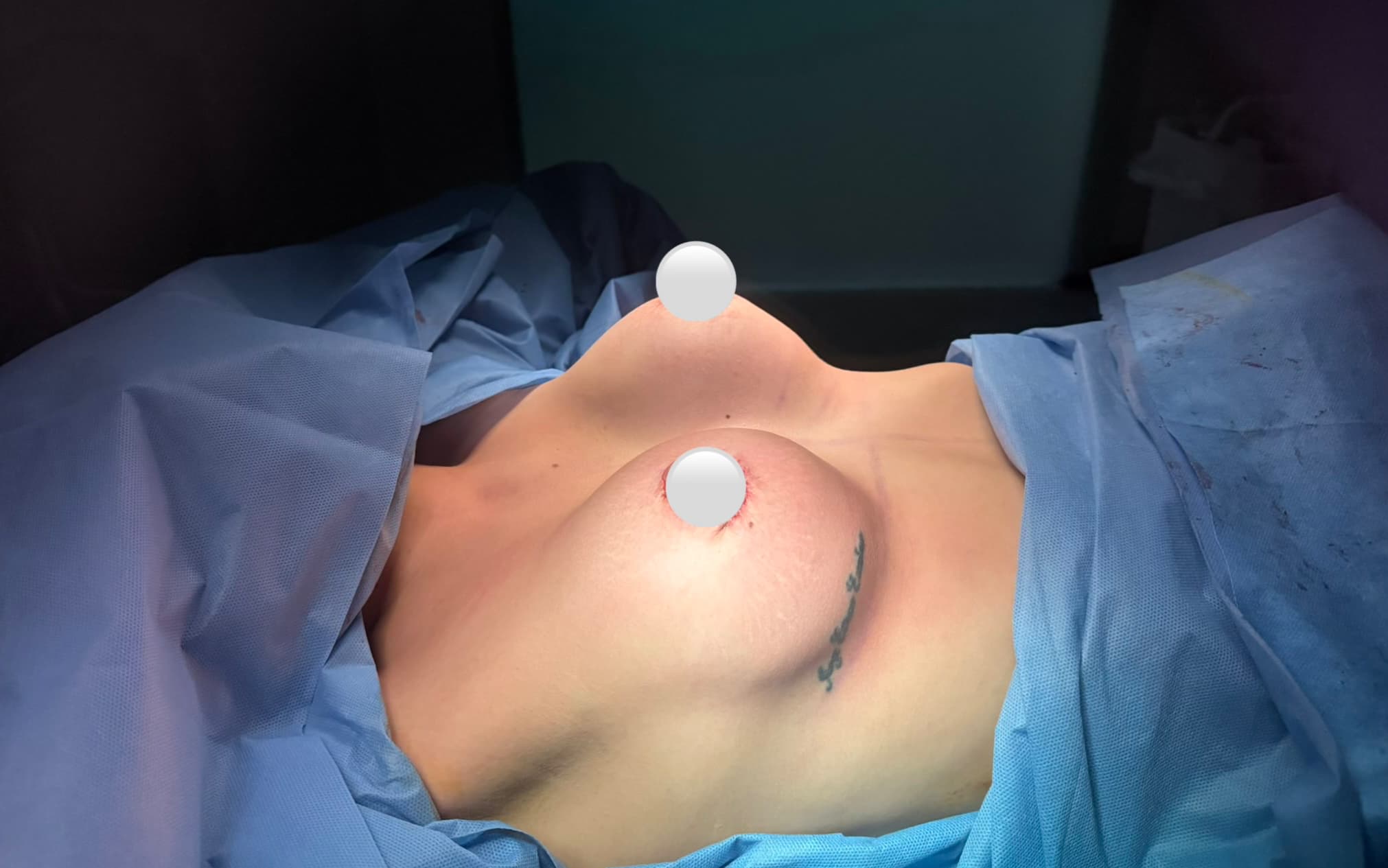 After Augmentation mammaplasty