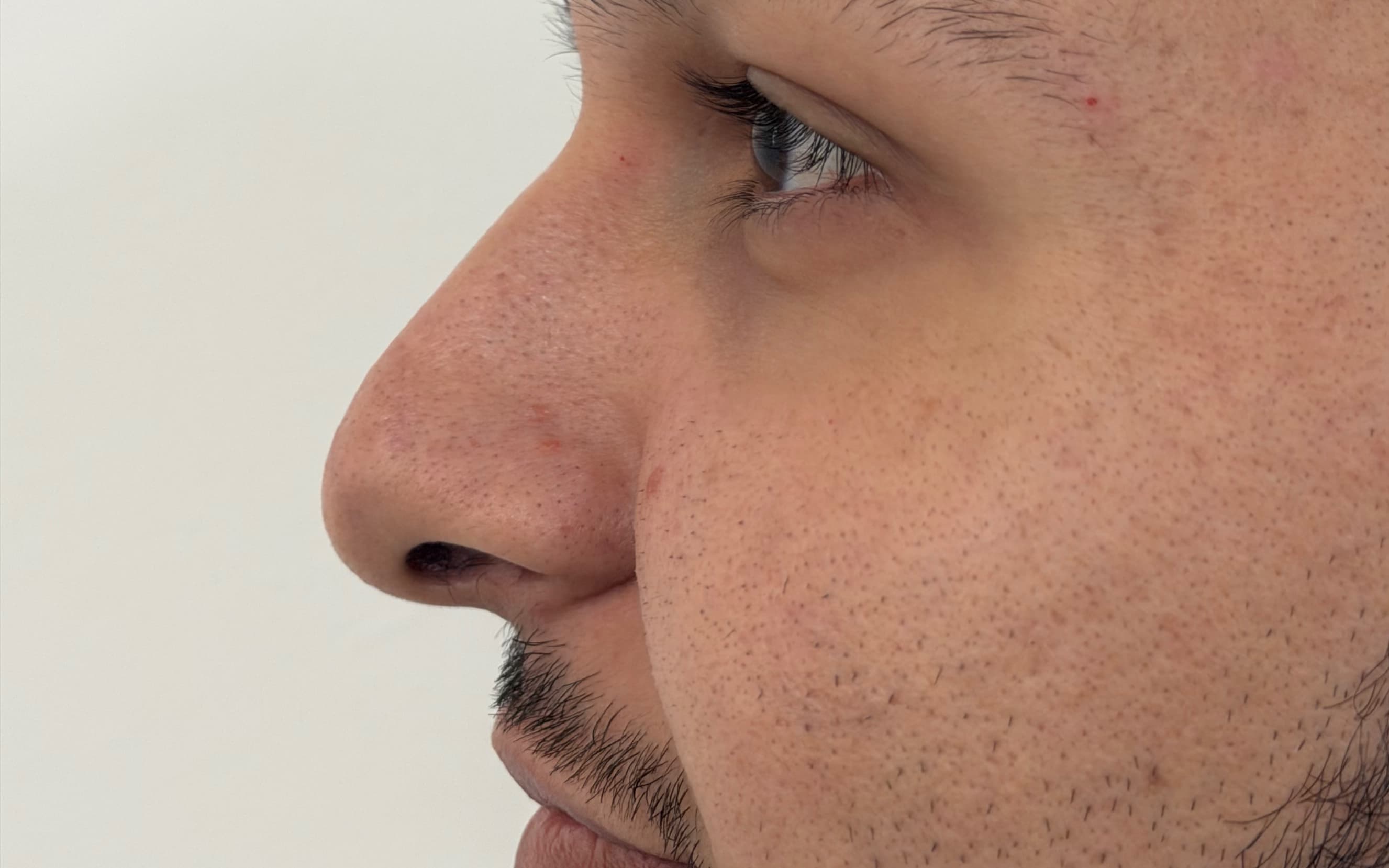 Before Male rhinoplasty