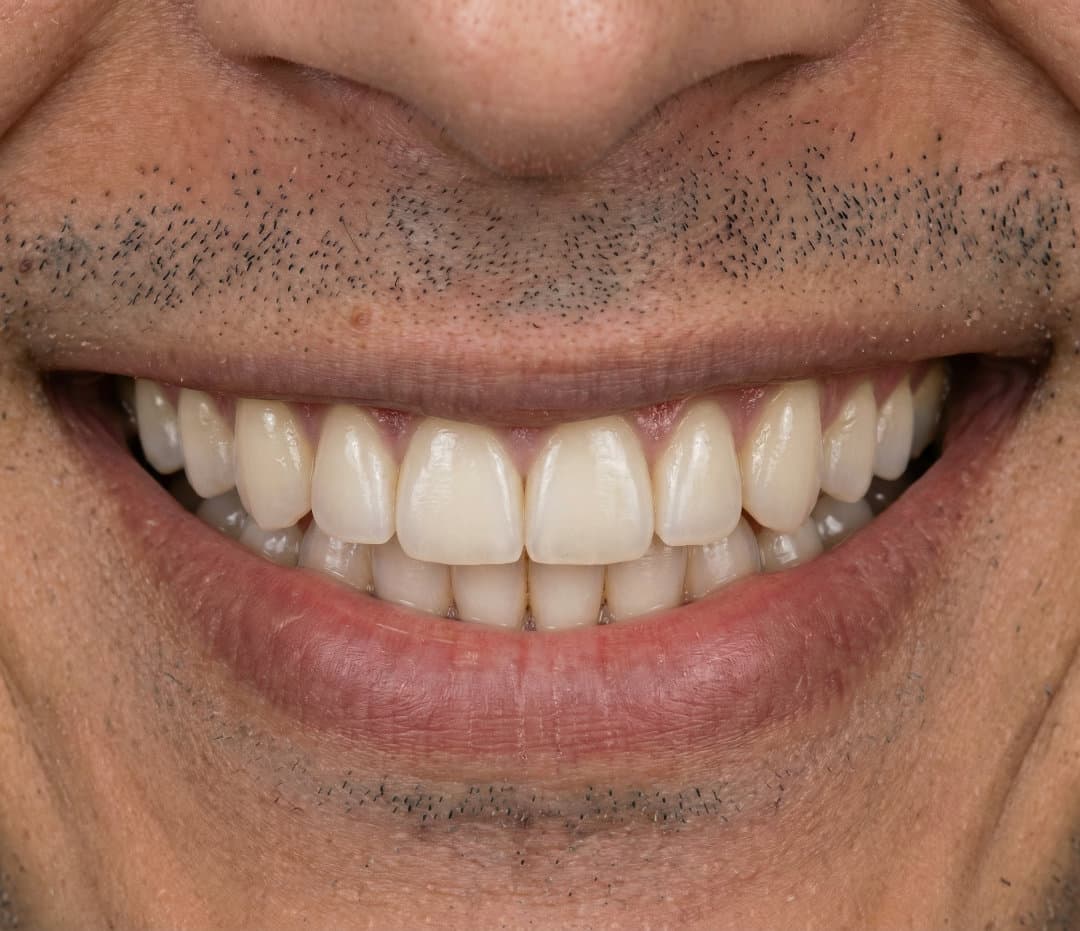 After Invisalign y diseño de sonrisa. 1 año