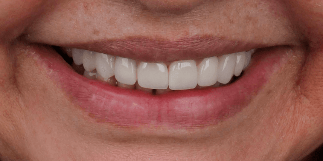 After Prótesis híbrida superior