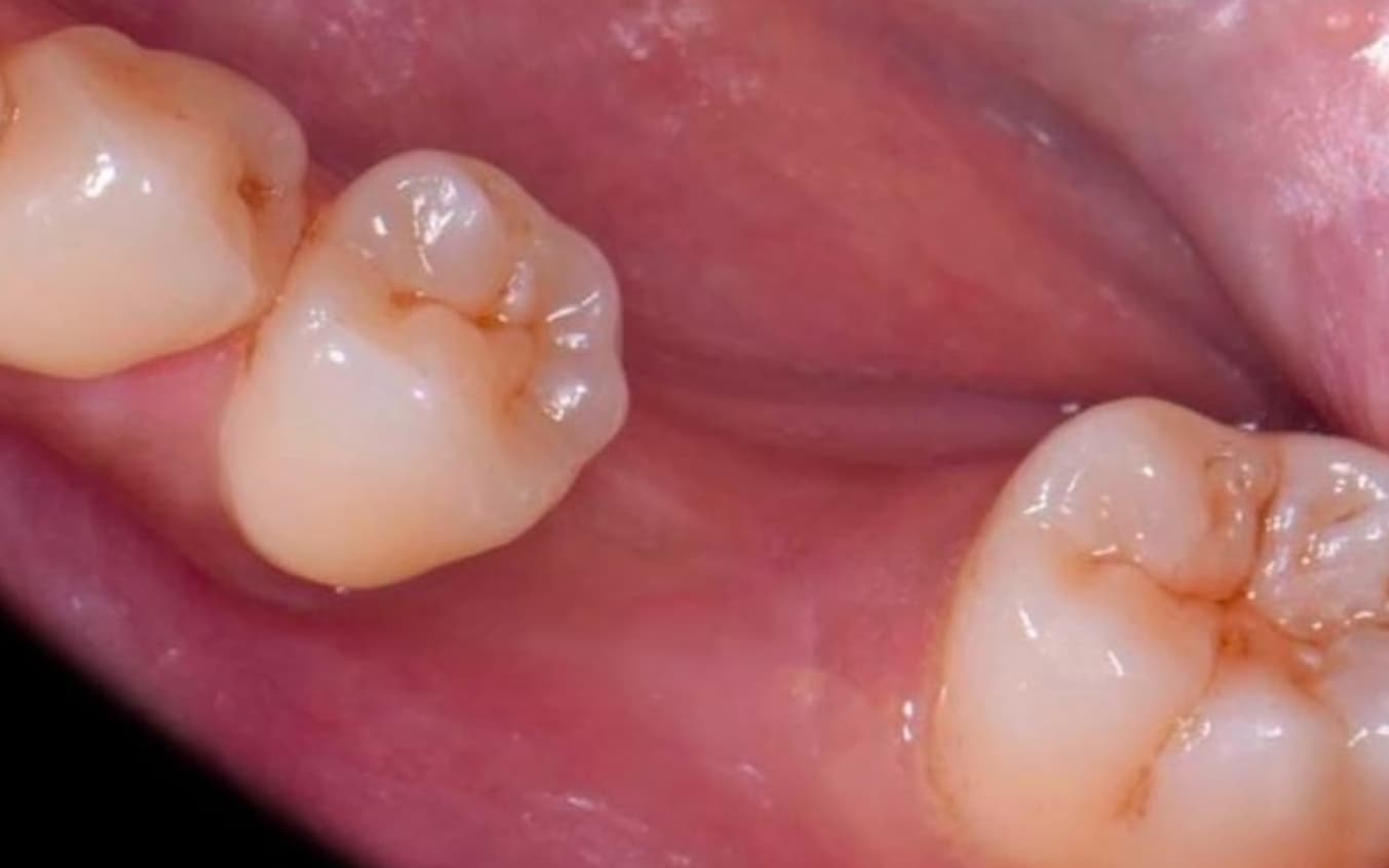 Before Crown on Dental Implant