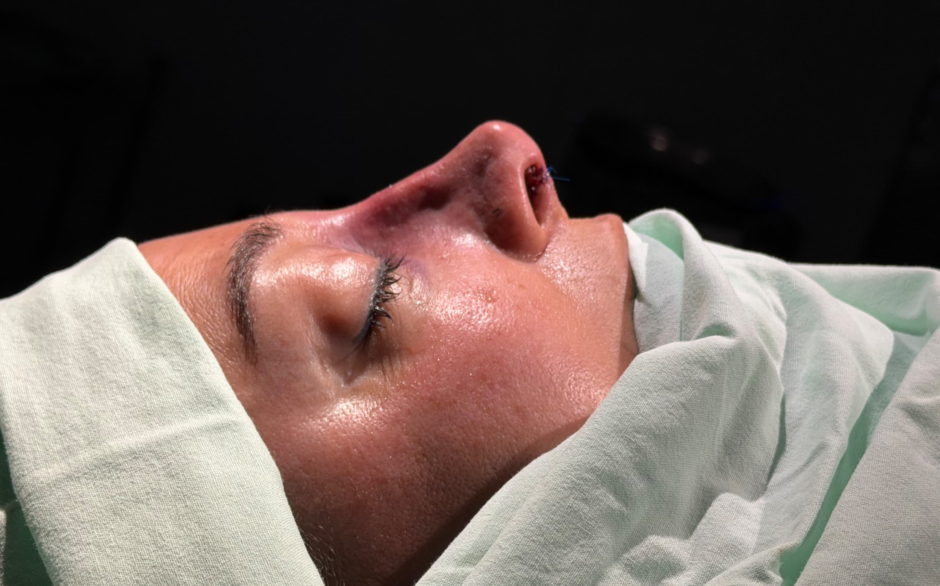 After Ultrasonic rhinoplasty