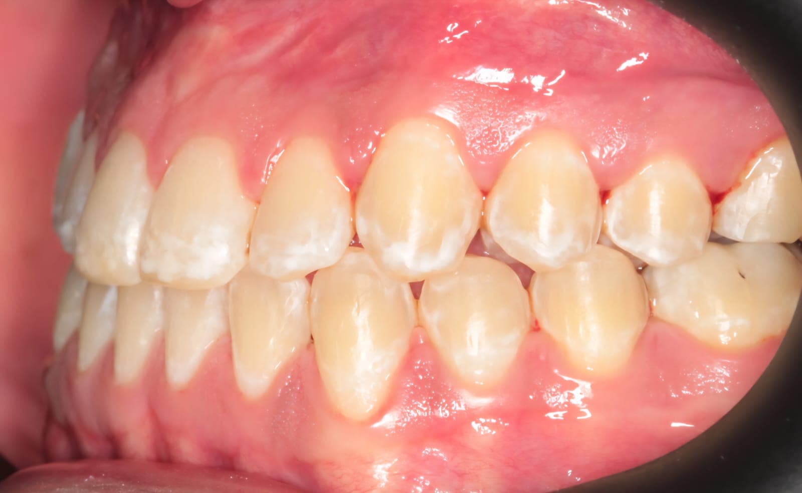 After Cirugia Ortognatica