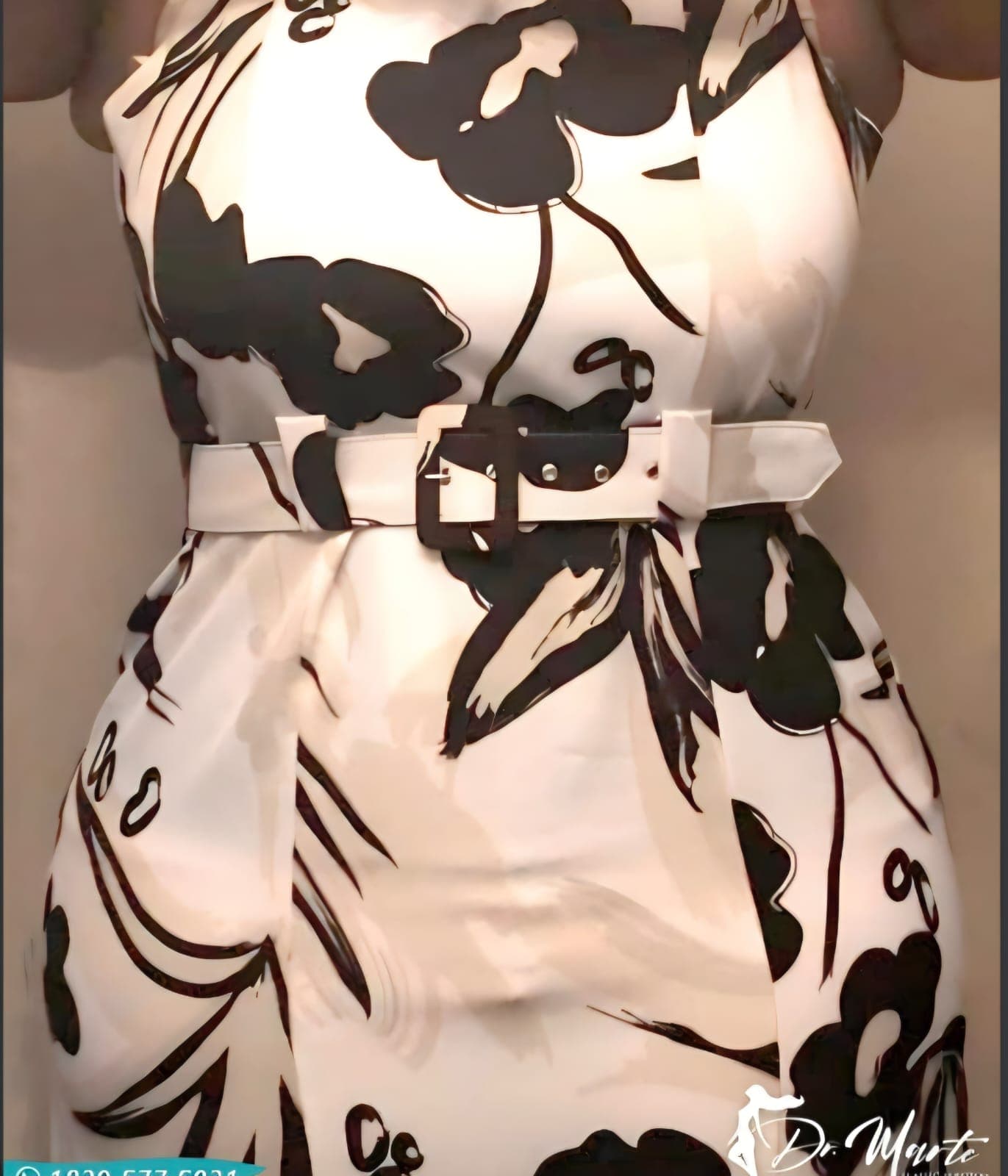 After Abdominoplastia (tummy tuck)