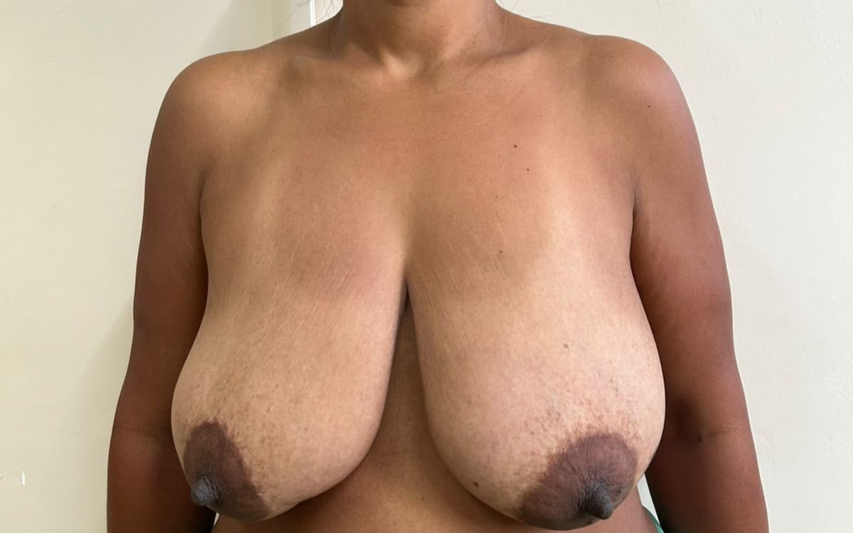 Before Mastopexy
