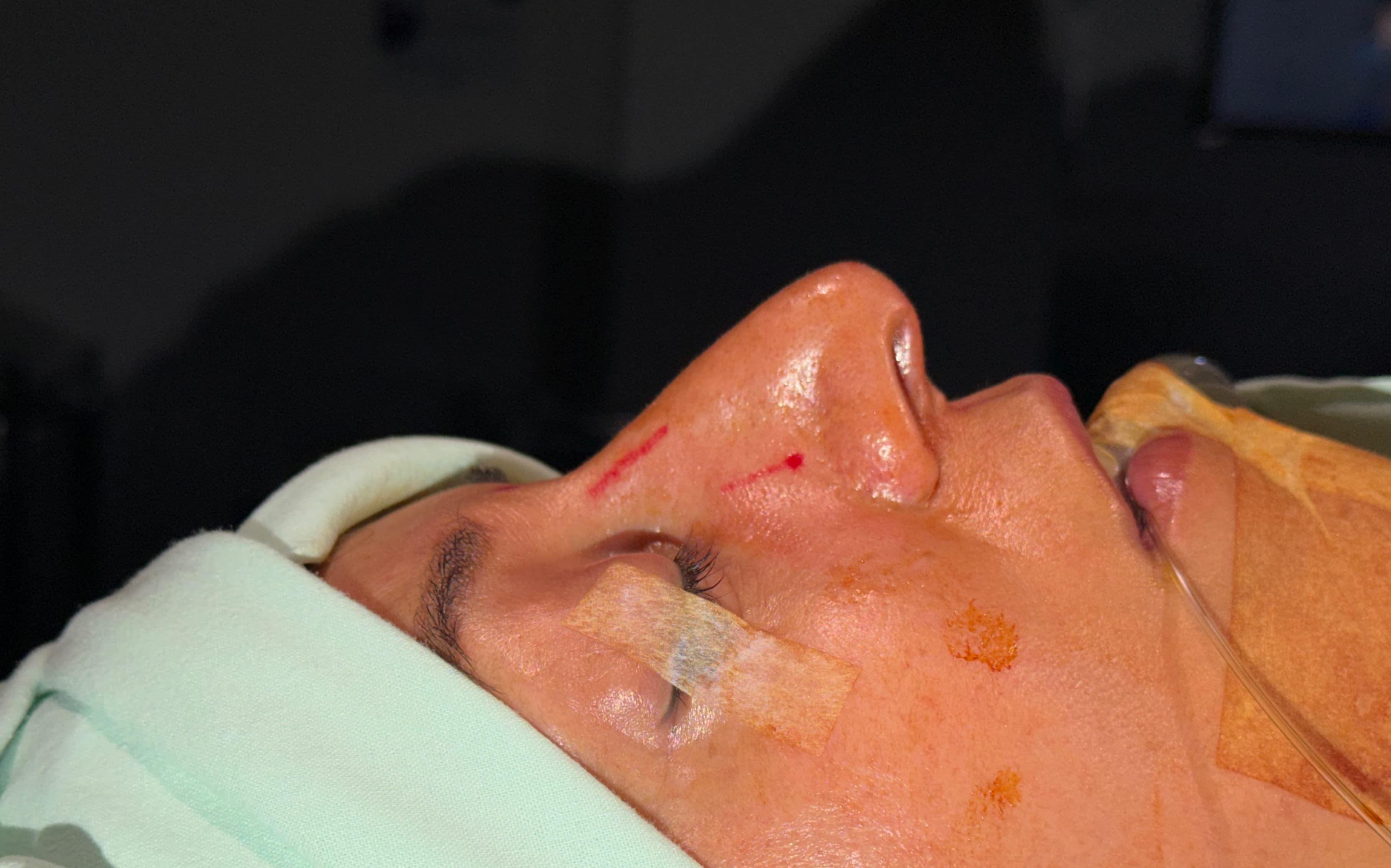 Before Ultrasonic rhinoplasty