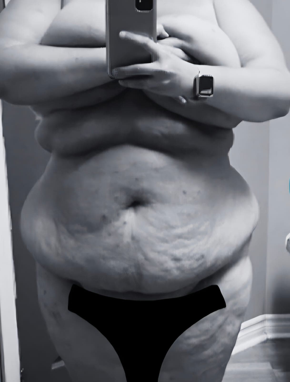 Before Abdominoplastia (tummy tuck)