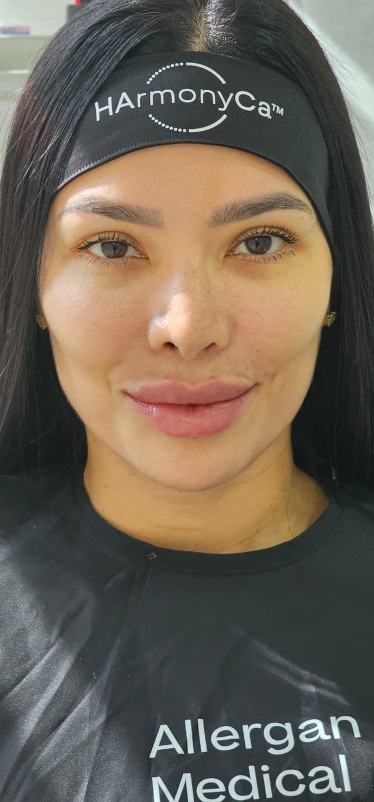 After Armonización facial
