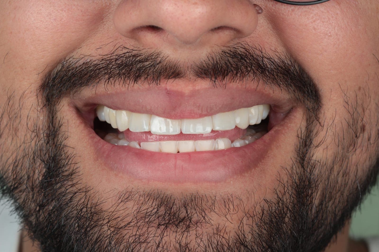 After Microdiseño en resina de alta estética