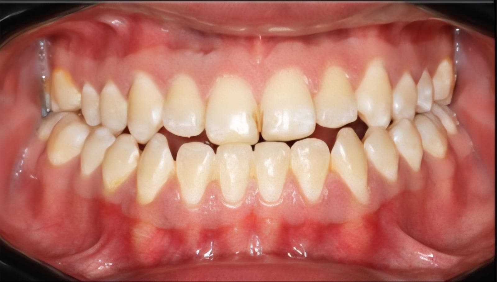 Before Cirugía Ortognatica