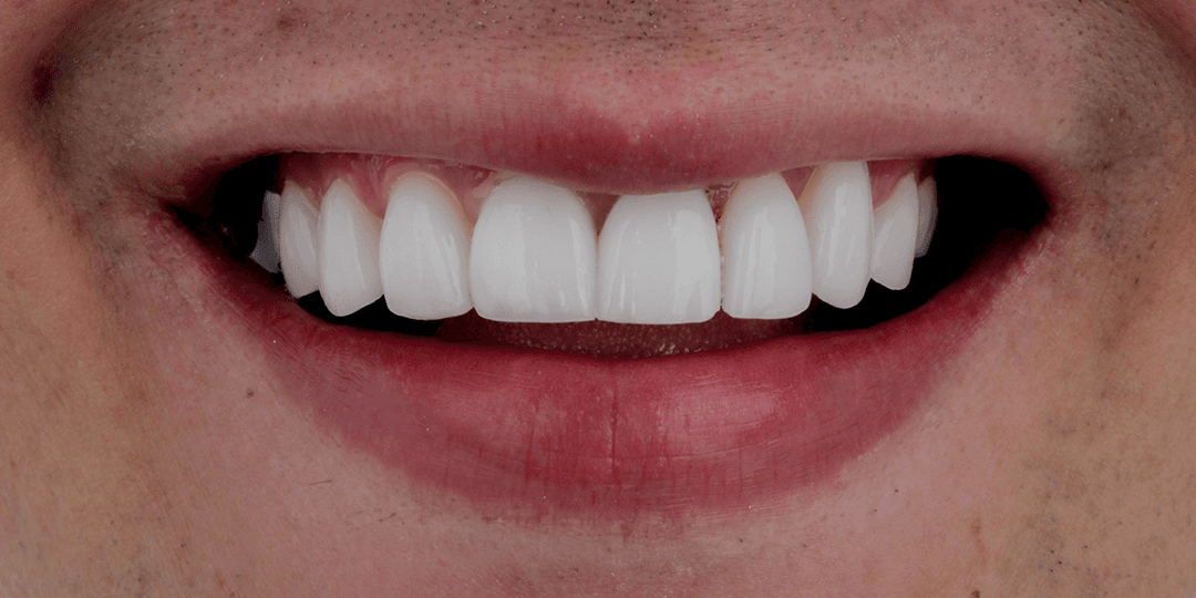 After Implante dental en zona estética + Diseño de sonrisa en cerámica