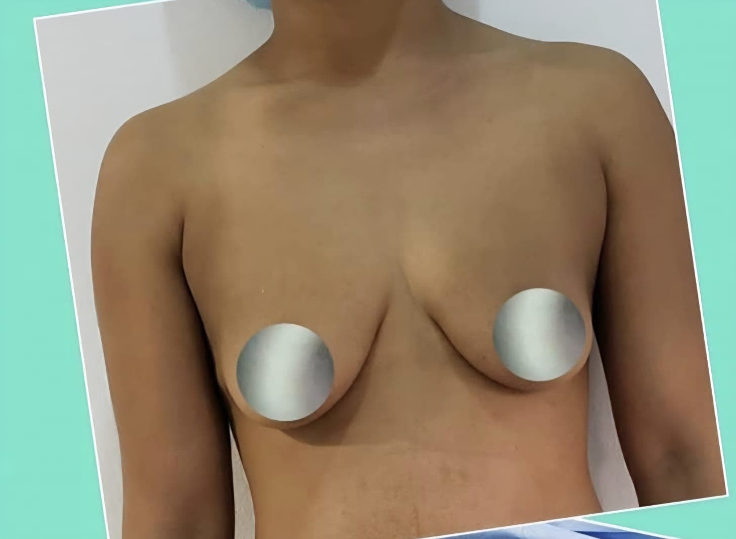 Before Implantes de senos