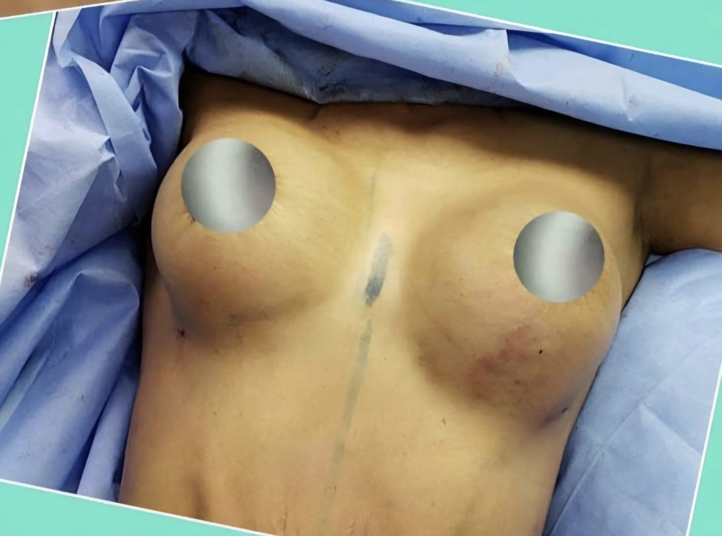 After Implantes de senos