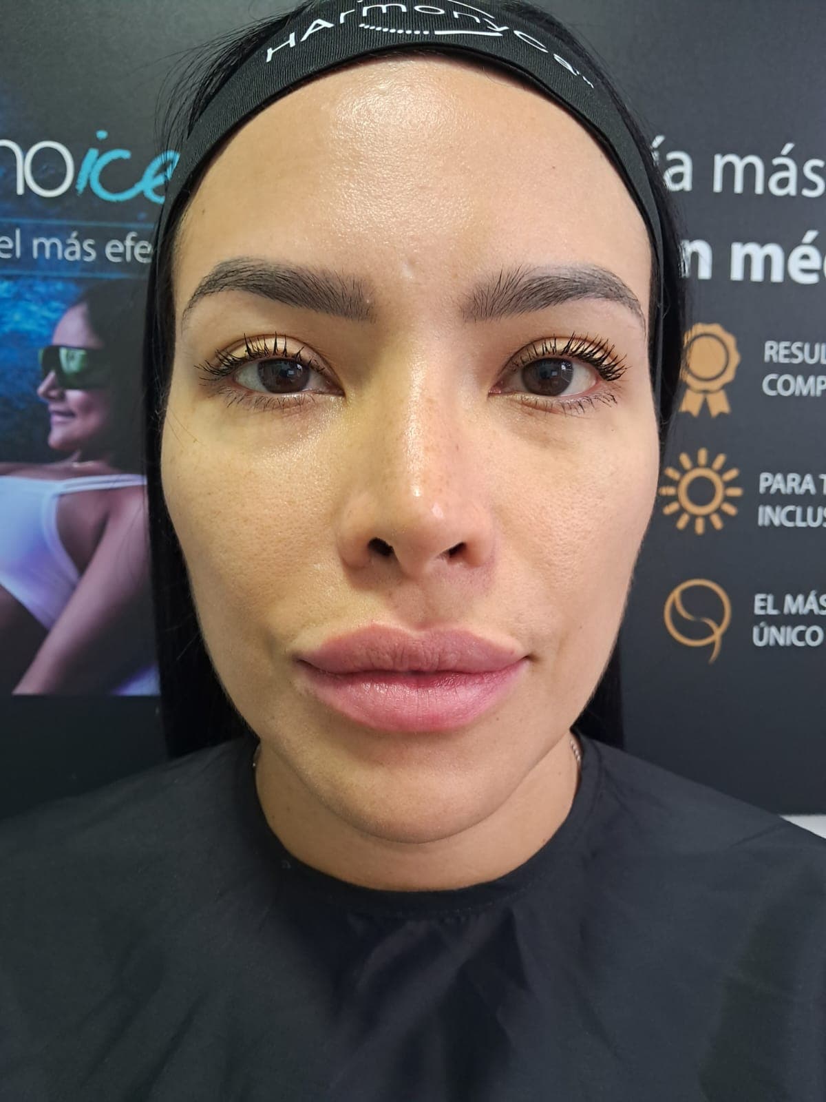 Before Armonización facial