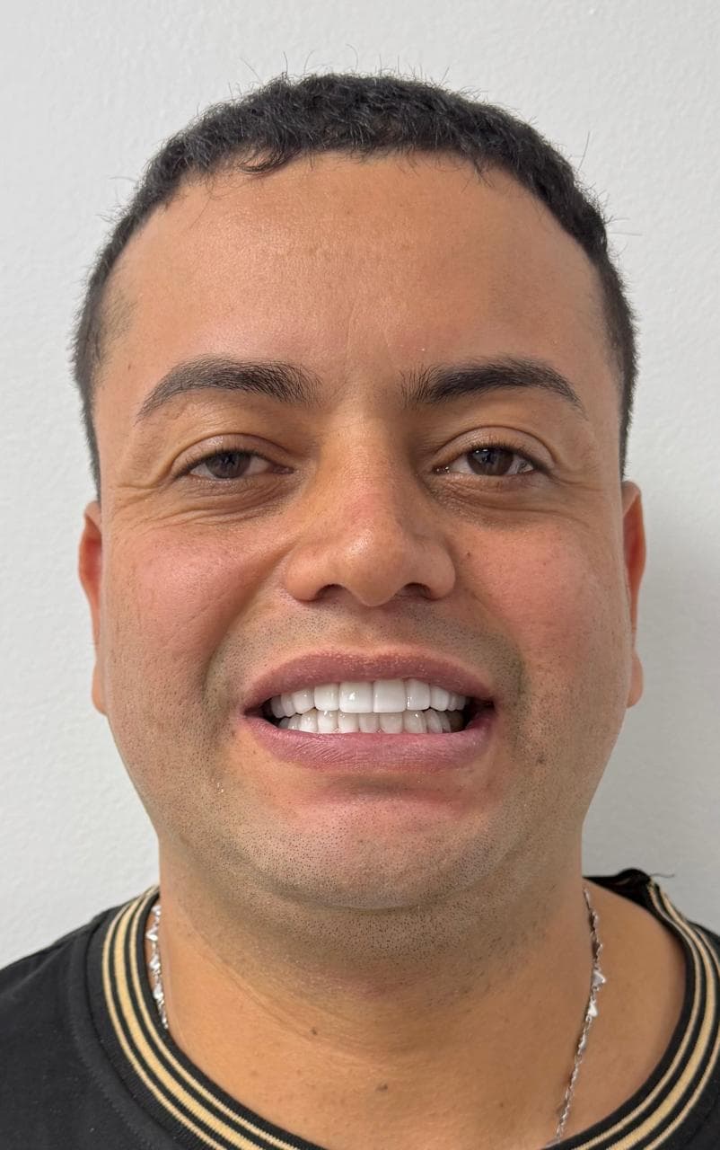 After LENTES CERAMICOS