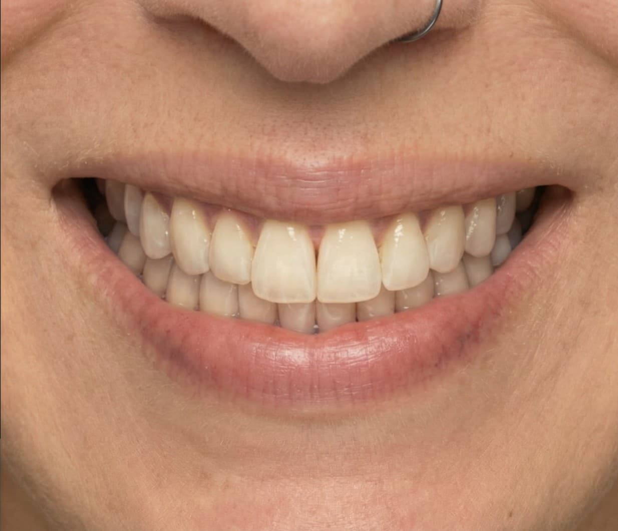 After Invisalign y diseño de sonrisa. 8 meses