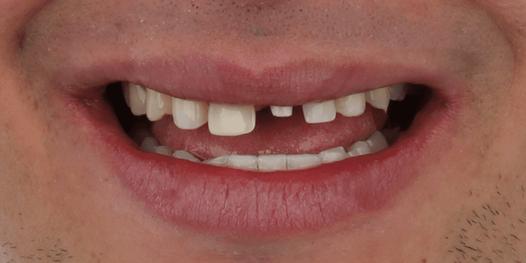 Before Implante dental en zona estética + Diseño de sonrisa en cerámica