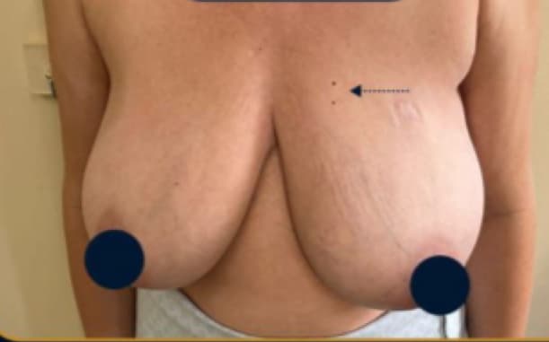 Before Reduction mammaplasty
