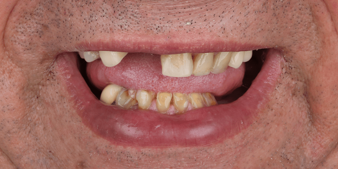 Before Prótesis híbrida bimaxilar