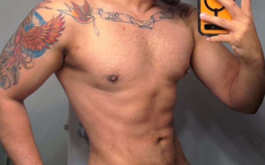 After Male liposuction + gynecomastia correction