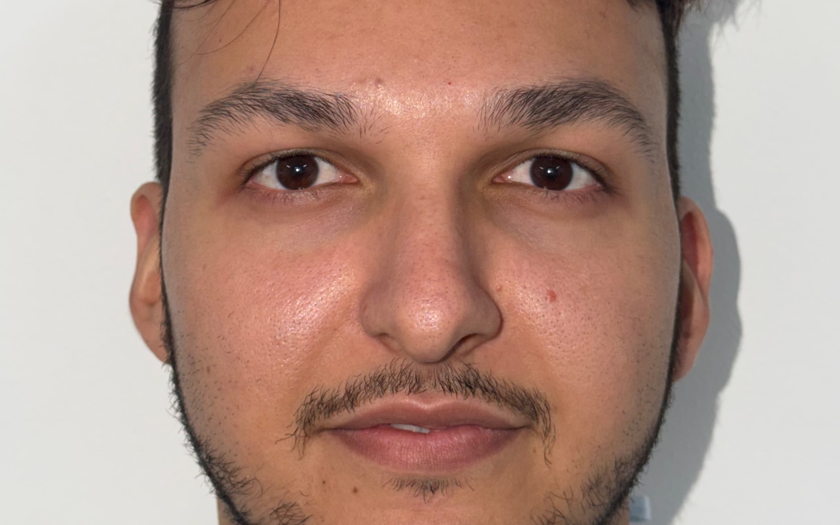 Before Male rhinoplasty