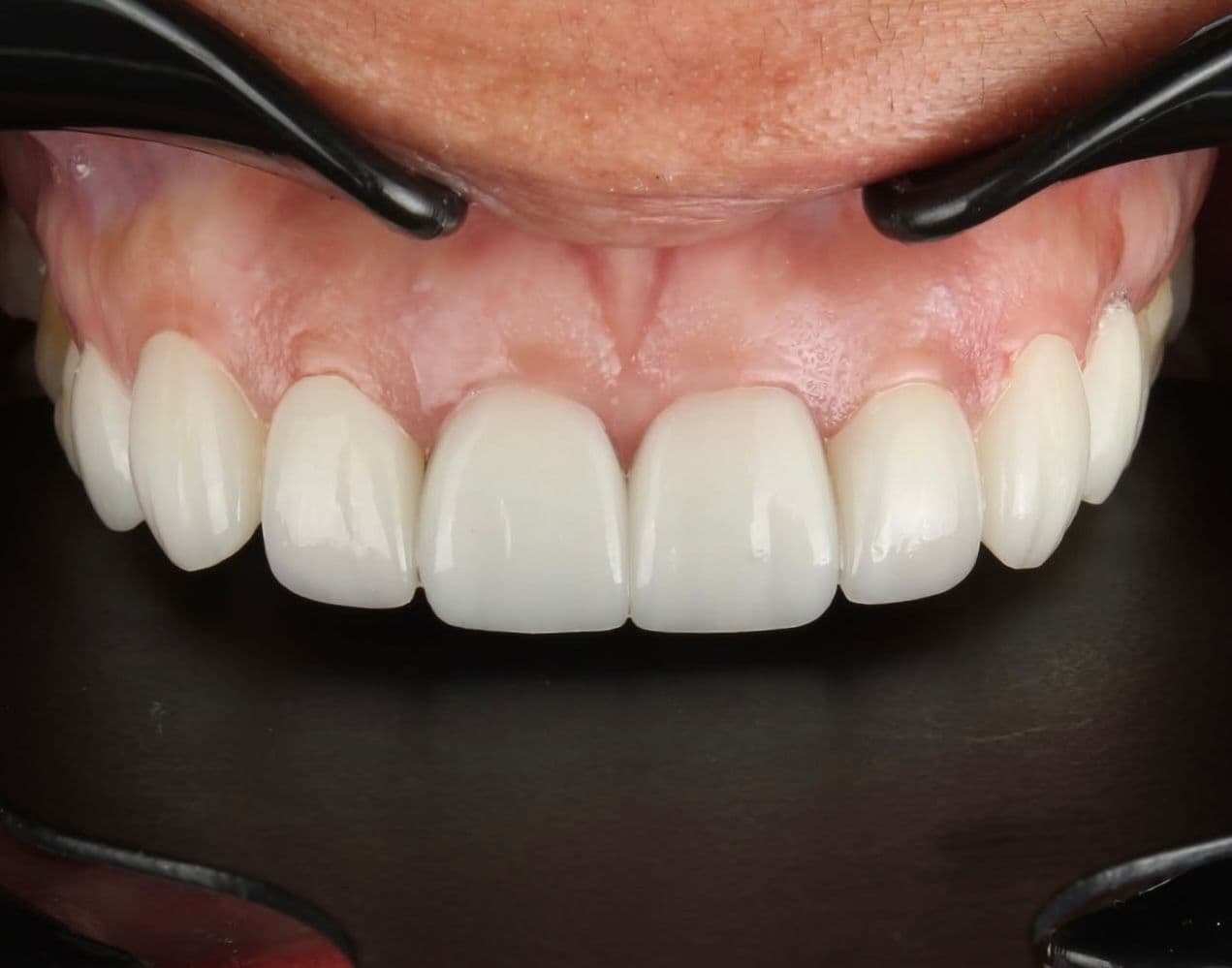 After carillas dentales en cerámica