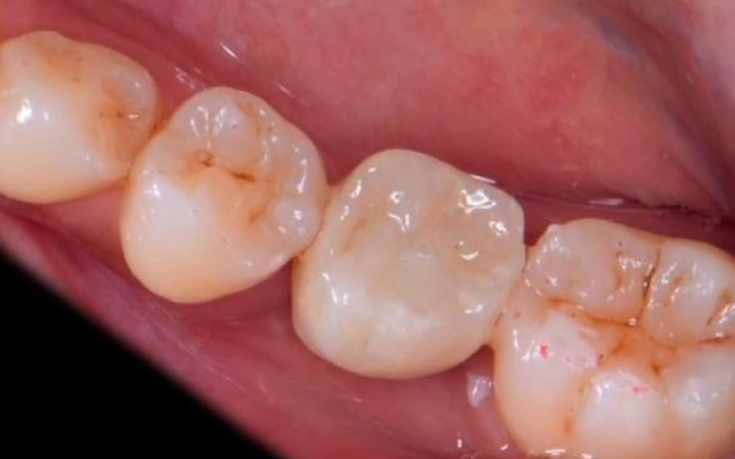 After Crown on Dental Implant