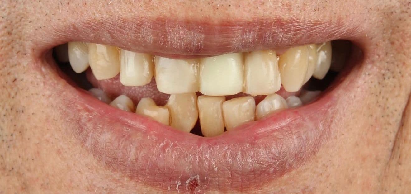 Before carillas dentales en cerámica