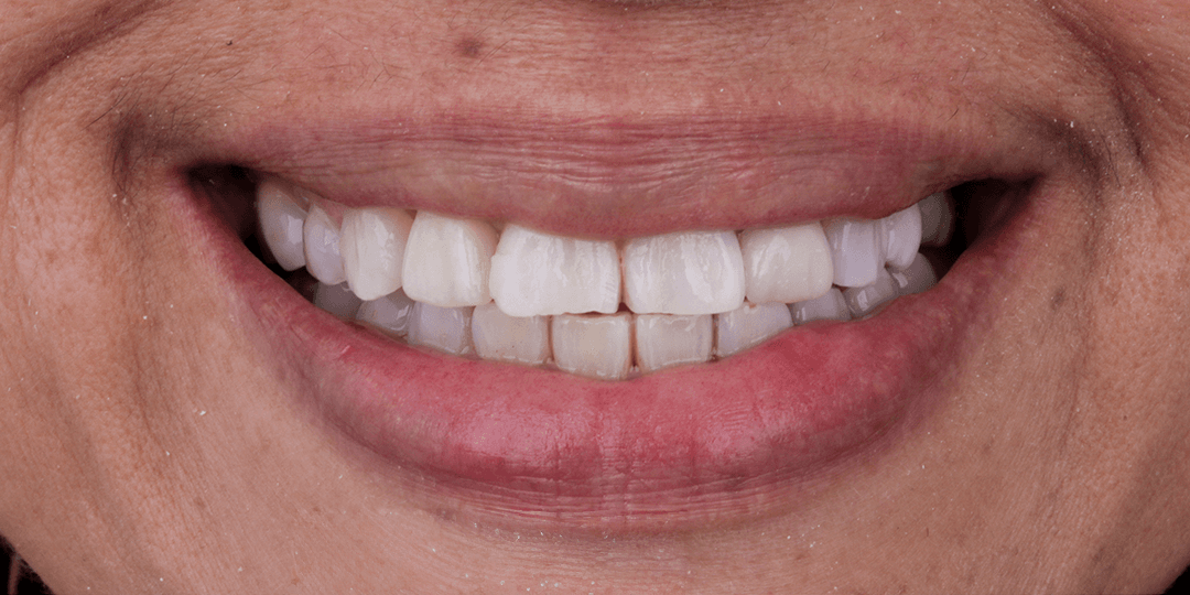 After Implante dental de zirconio en zona estética