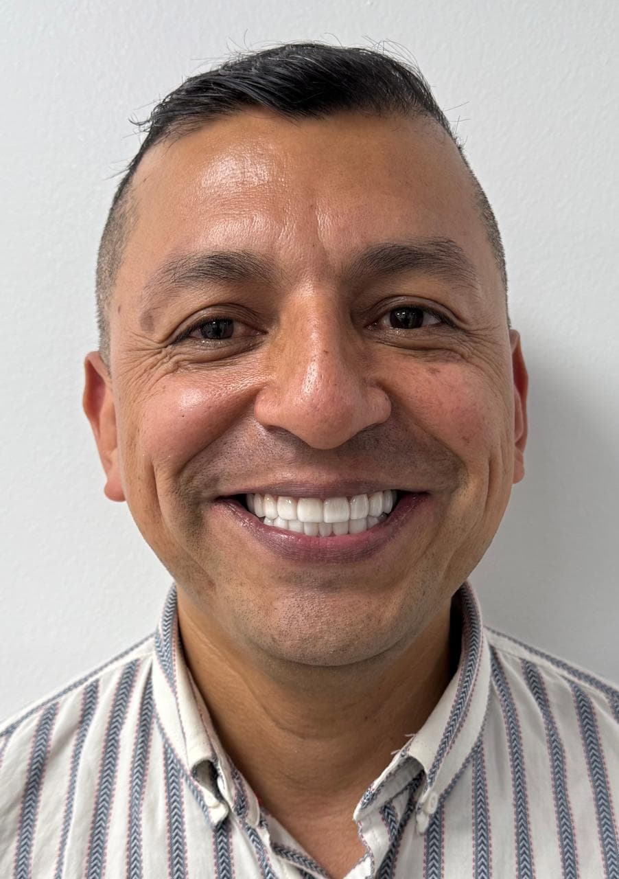 After REHABILITACION COMPLETA CON LENTES CERAMICOS