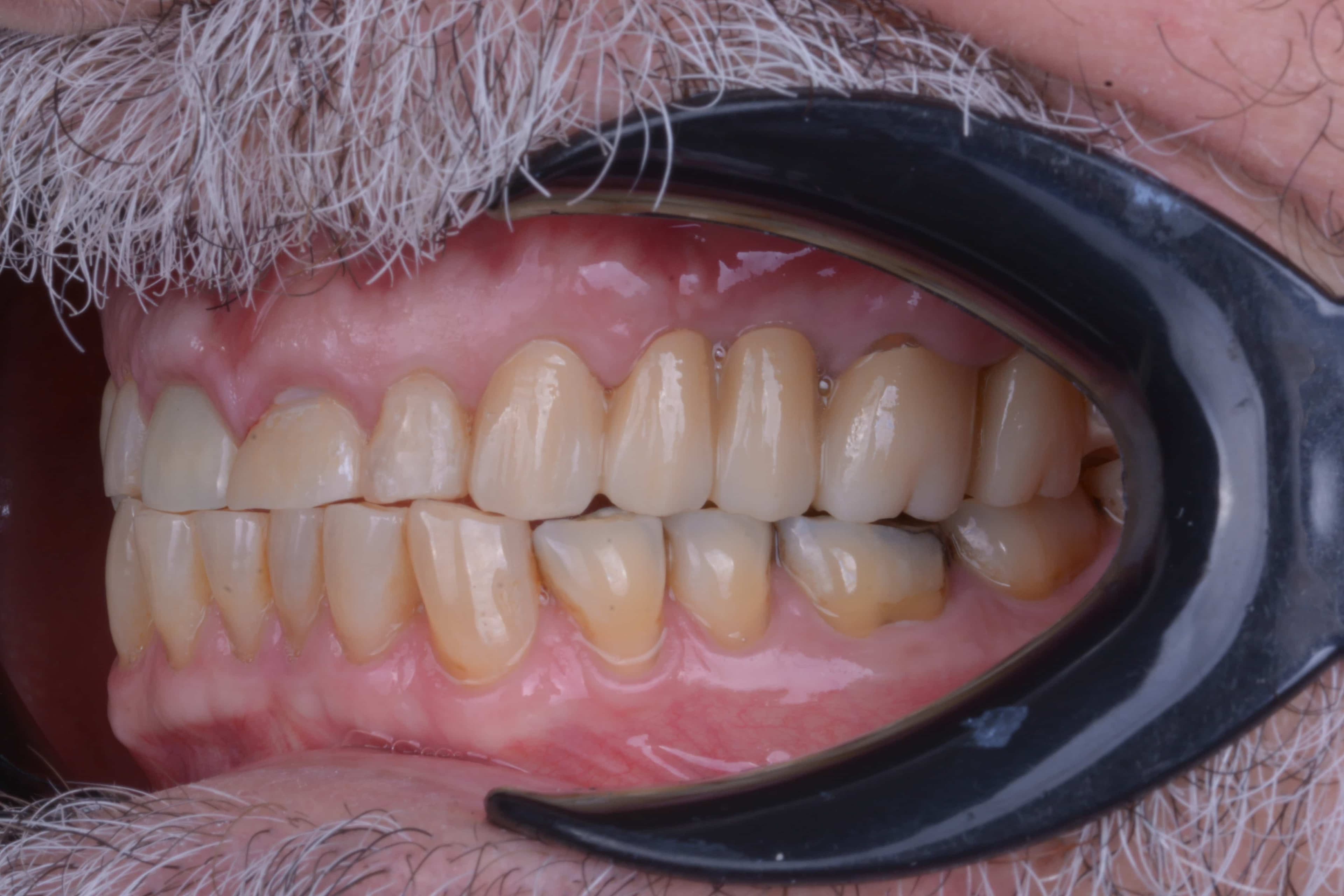 After Puente fijo en zicornia