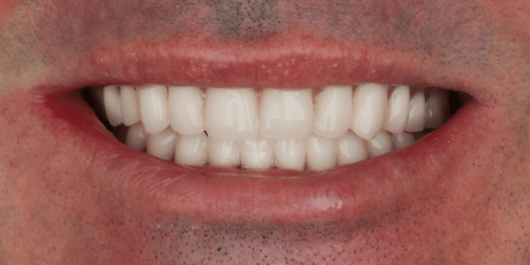 After Prótesis híbrida bimaxilar